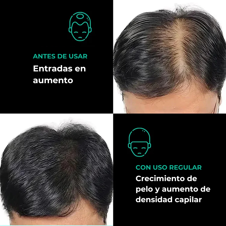 Ouhoe™ | Aceite natural para el crecimiento del cabello
