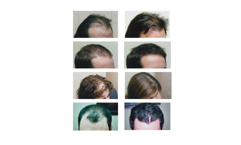 Ouhoe™ | Aceite natural para el crecimiento del cabello