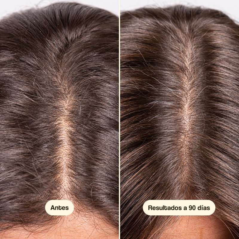 Minoxidil™ | Sérum Para el Crecimiento del Pelo