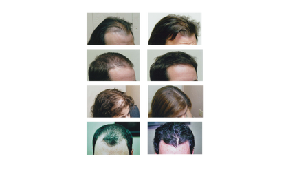 Ouhoe™ |  Aceite natural para el crecimiento del cabello